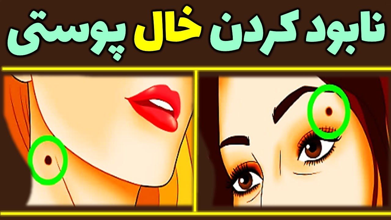 از بین بردن خال های صورت | برداشتن خال صورت | برداشتن خال گوشتی - YouTube