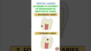 Backward caries and Forward caries#dental #dentistry #dentist #dentaleducation #caries