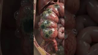 What Happens When Your Appendix Bursts