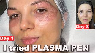 Plasma Pen around my eyes - Aesthetician unfiltered day by day recovery & before and after results