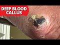 Is a blood callus dangerous satisfying debridement