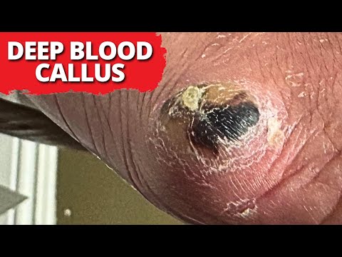 Is A Blood Callus Dangerous?? (Satisfying Debridement)