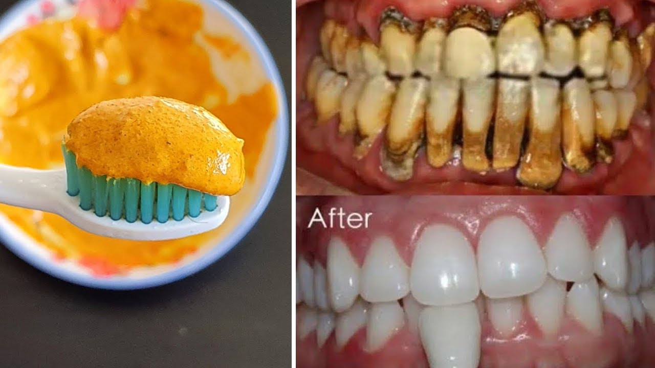 Teeth whitening at home in 3 minutes How to naturally whiten your