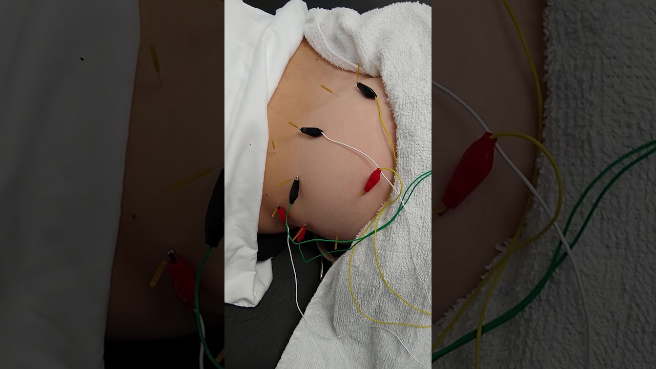 Dry Needling to Posterolateral Hip YouTube