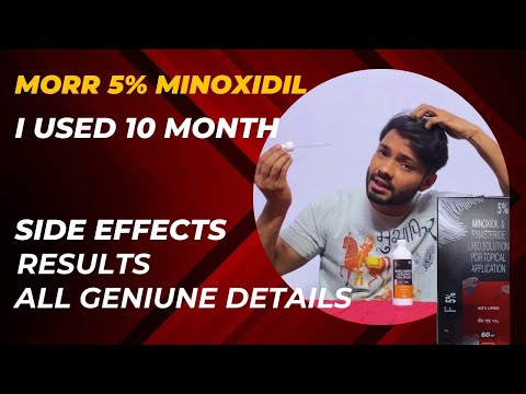 Minoxidil Morr f 5 Results || Morr F 5 || Minoxidil and finasteride side effects