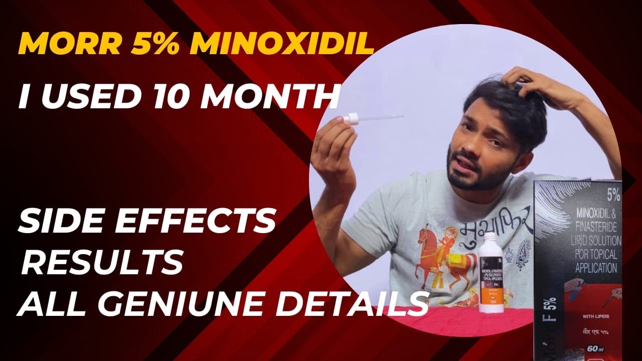 Minoxidil Morr f 5 Results || Morr F 5 || Minoxidil and finasteride side effects