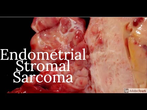 Video: JAZF1 / SUZ12-genfusie In Endometriumstromale Sarcomen