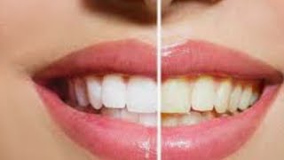 تبييض الأسنان وإزالة الإصفرار من اول مرة والنتيجة روعة ??