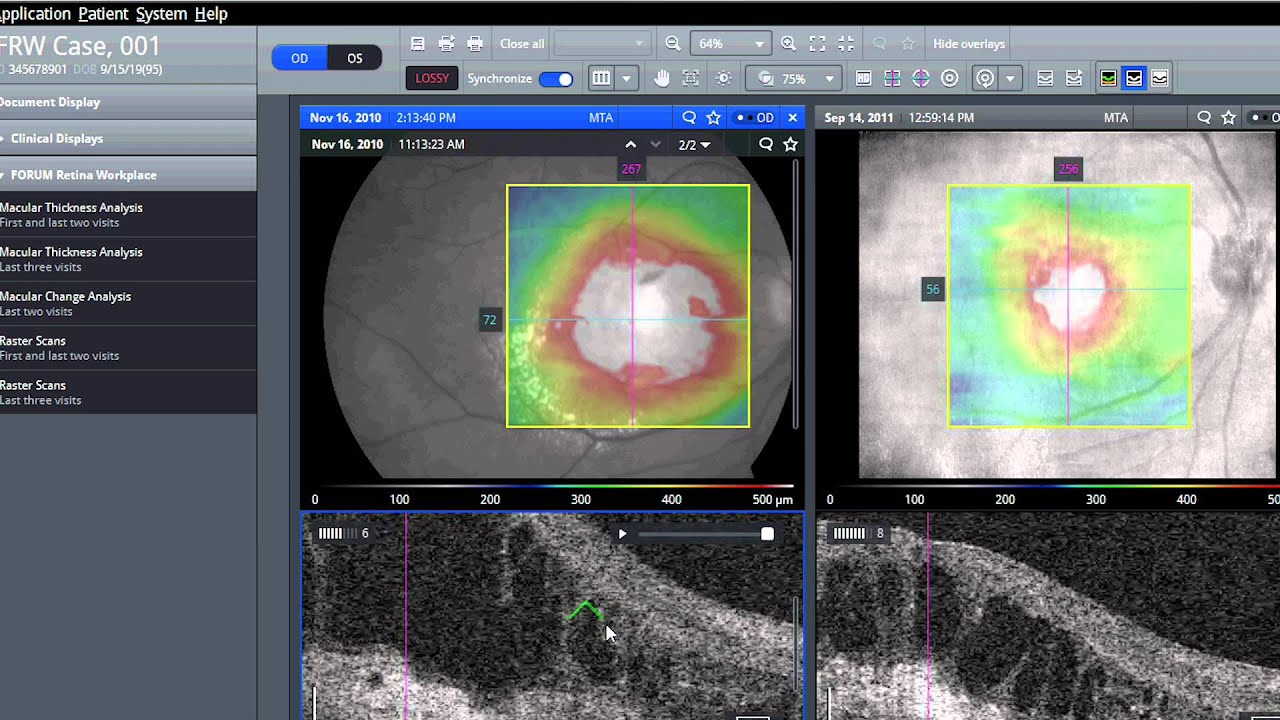 ZEISS Retina Workplace Assess macular disease in seconds YouTube