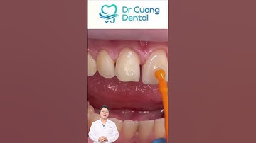 GẮN RĂNG SỨ | GIẢI PHÁP TỐI ƯU NHẤT KHI BỊ THƯA RĂNG |Dr Cường Offical| #drcuong #bocrangsu