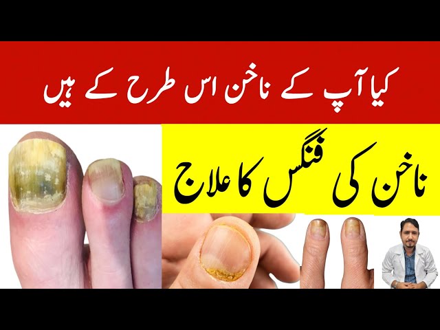 Onychomycosis: A Look Into This Nail Condition - HealthKart