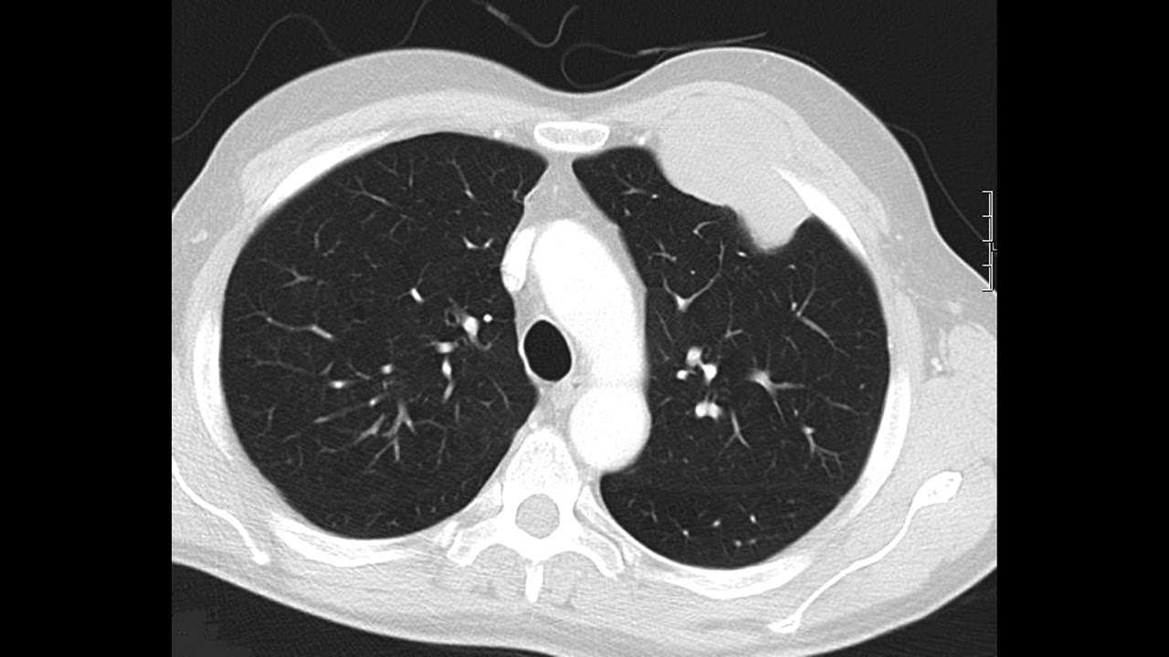 mesothelioma tnm