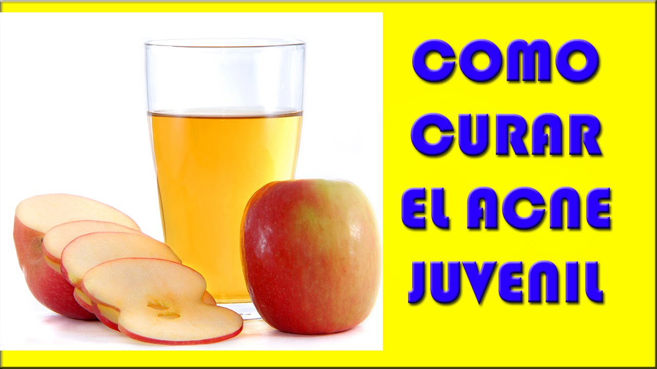 remedios naturales contra el acne juvenil