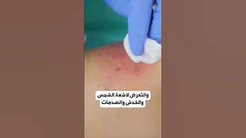 أسباب بسيطة وأخرى خطيرة تقف وراء عدم شفاء الجروح عليك معرفتها 