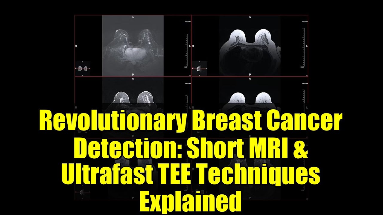 Революционное обнаружение рака молочной железы: объяснение методов короткой МРТ и сверхбыстрой чр...