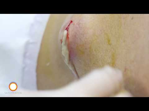 Infected sebaceous cyst removal