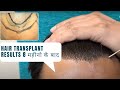 Hair Transplant Results After 8 Months | Hair Transplant Before & After Results | Dr Jangid