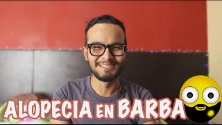 Alopecia Areata en la Barba