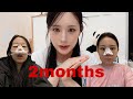目,鼻整形をして2ヶ月のダウンタイム過程お見せします❕#韓国整形