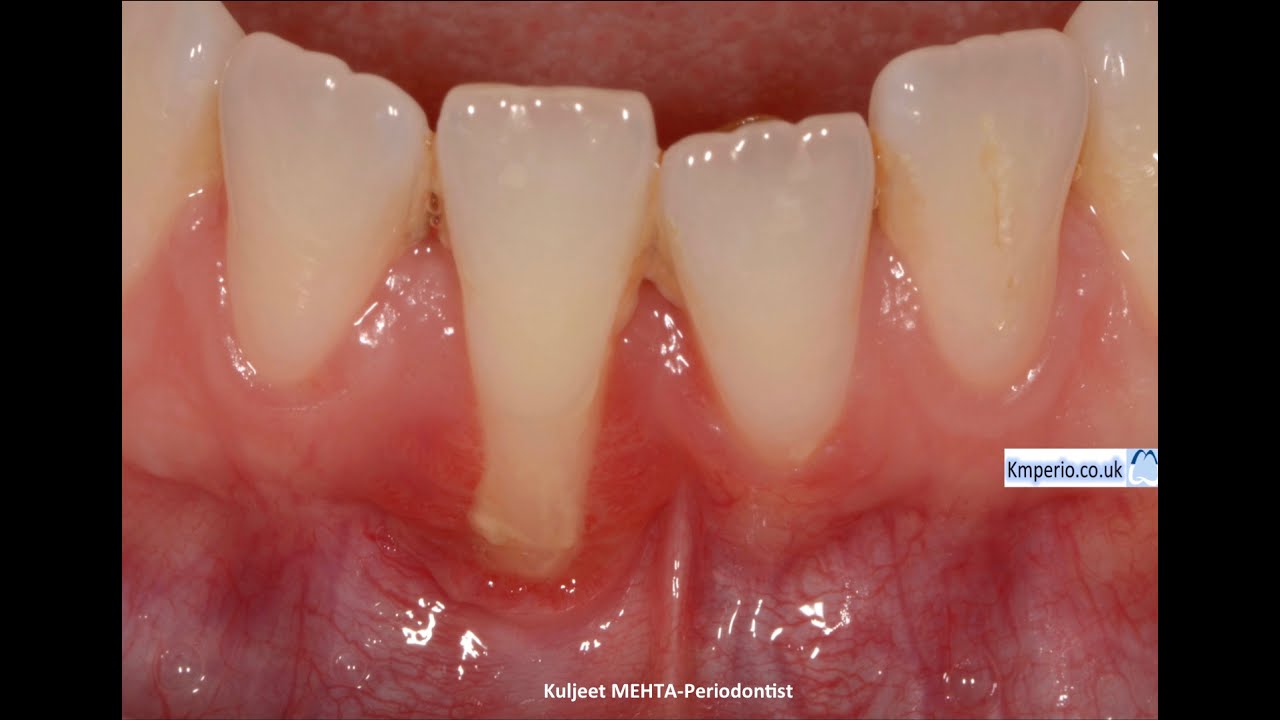 Gum (Gingival) Recession Surgery Treated with Gum Graft. 