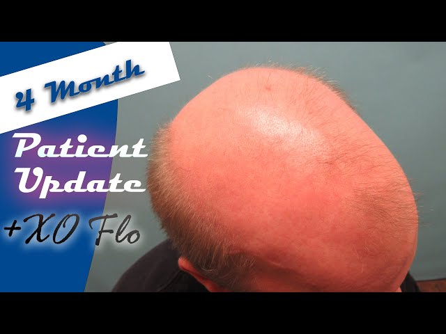 Norwood 7 Hair Loss Treatment - Patient Update with Adam