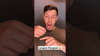 Longest Hangnail Ever
