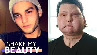 My Face \& Double-Hand Transplant Was The World's First | SHAKE MY BEAUTY