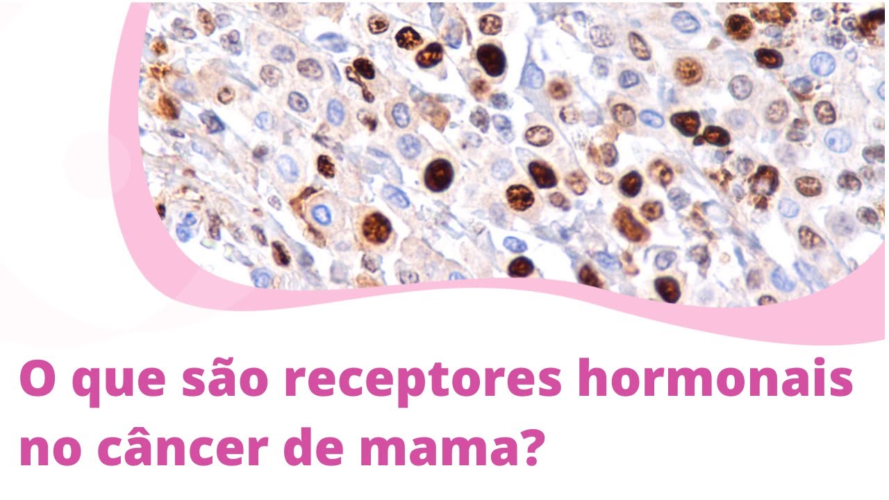 cancer hormonal mama clinica de slabit cu internare