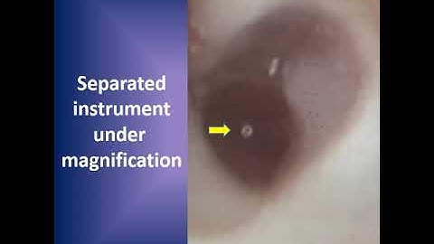 Bypassing a separated instrument in a root canal