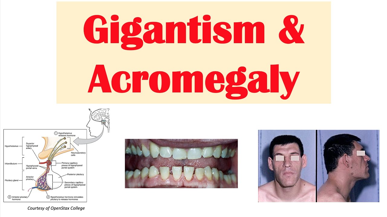 Gigantism  Acromegaly | Growth Hormone, Signs  Symptoms, Diagnosis, Treatment
