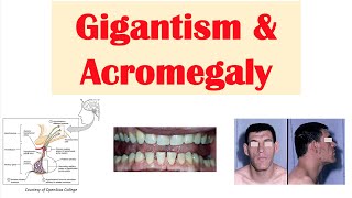 Gigantism & Acromegaly | Growth Hormone, Signs & Symptoms, Diagnosis, Treatment