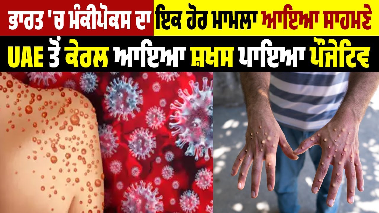 ਭਾਰਤ 'ਚ Monkeypox ਦਾ ਇਕ ਹੋਰ ਮਾਮਲਾ ਆਇਆ ਸਾਹਮਣੇ, UAE ਤੋਂ Kerala ਆਇਆ ਸ਼ਖਸ ਪਾਇਆ Positive