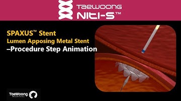 Niti S™ SPAXUS™ Stent Procedure Step Animation