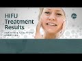 HIFU Treatment Results - What to expect from a SINGLE treatment | 2022