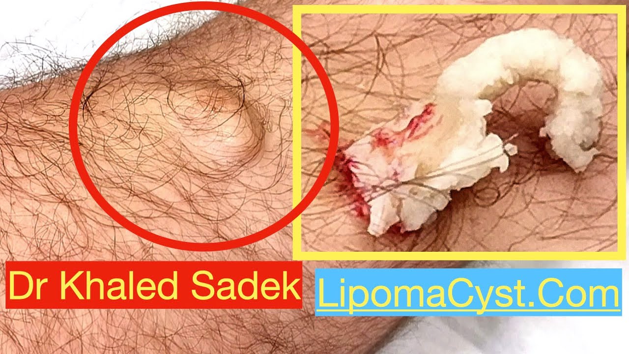 Epidermal cyst endless discharge and pockets.
