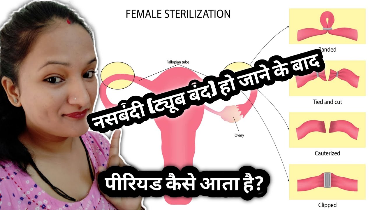 Nasbandi ke baad Period kaise hota hai Female sterilization