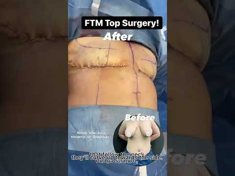 FTM Top Surgery! The Patient Was THRILLED With Their New Chest!
