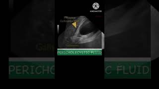 Acute cholecystitis on ultrasound #ultrasound