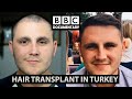 Greffe de cheveux turquie  documentaire de la bbcle rsultat de paul avant aprs
