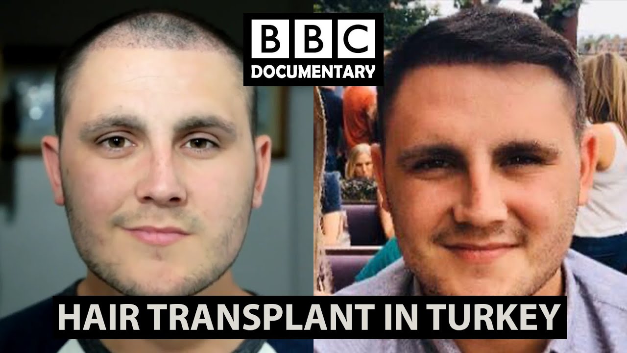 Hair Transplant Turkey - £1250 - Free UK Consultation