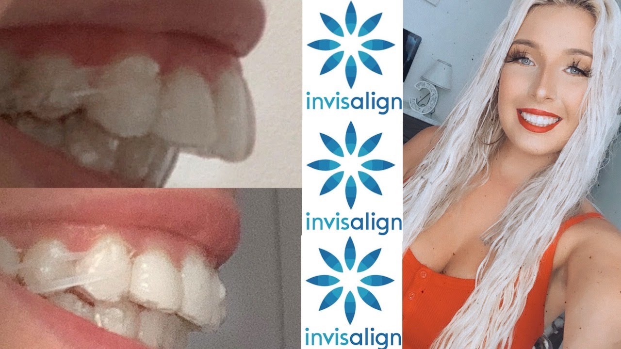 Invisalign Overbite Correction 11 Month Update With Before And After Pics Youtube 