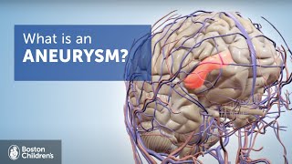 Brain Aneurysms | Boston Children