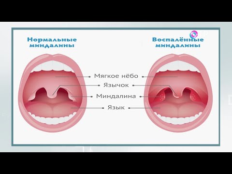 Видео: Является ли тонзиллит заразным? То, что вы должны знать