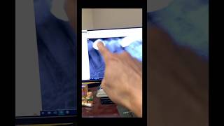 Would the RCT fail bc I went through a crown & did it in 1 appt even though tooth was abscessed?