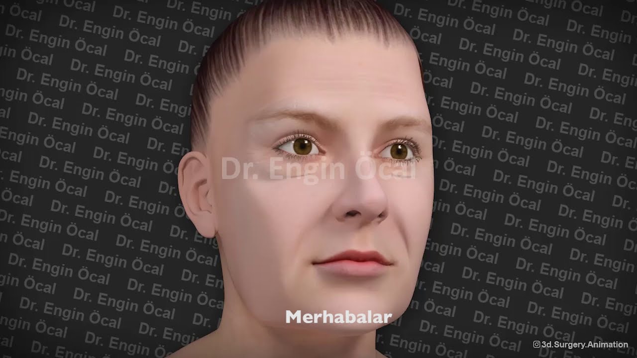 Face Lift - Yüz Germe Ameliyatı Nasıl Yapılır?