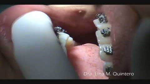 Forestadent Quick Brackets - Apertura y cierre de clips (Brackets autoligables)