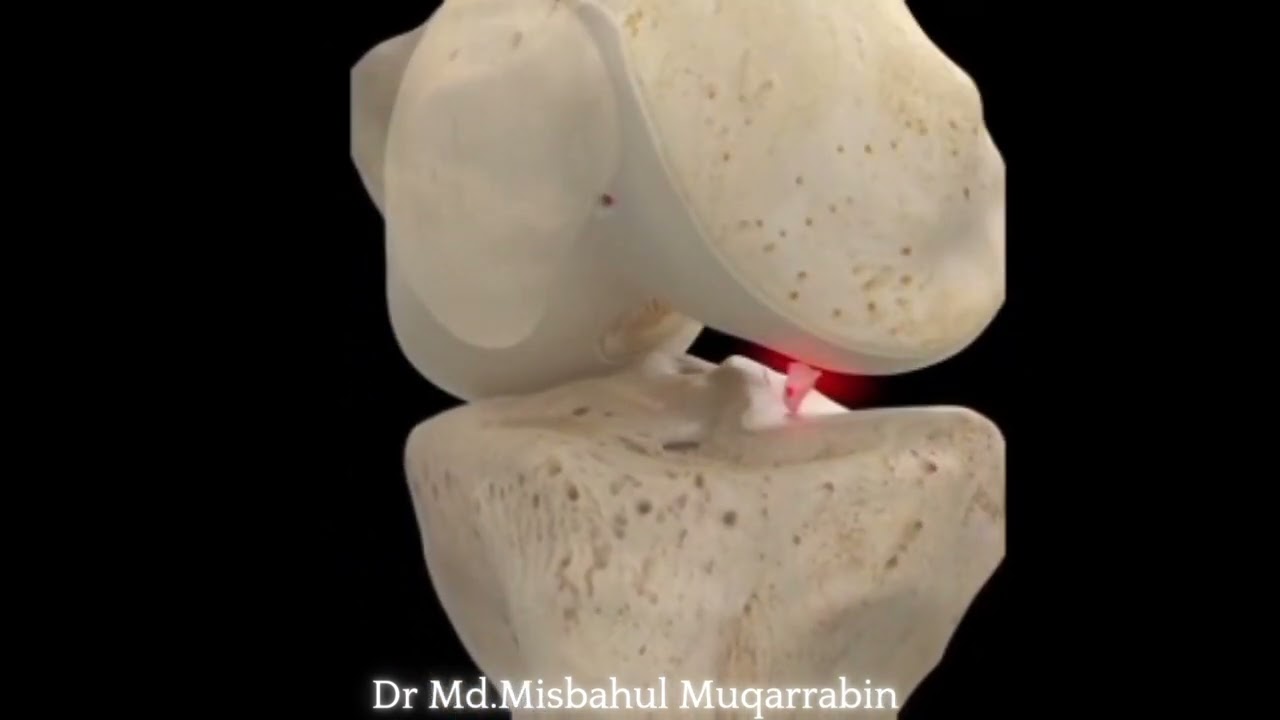 Loose Body in Knee Joint