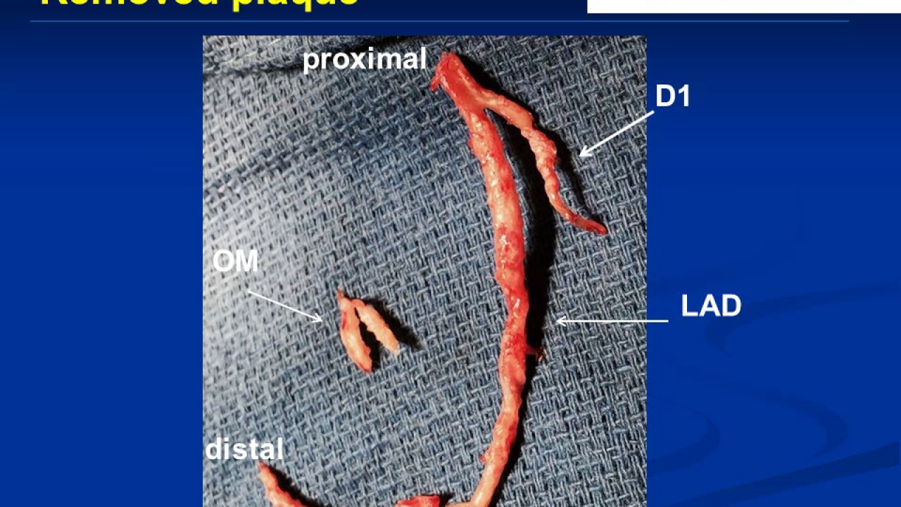 Coronary Endarterectomy Of The Left Anterior Descending Artery YouTube coronary-endarterectomy-of-the-left-anterior-descending-artery-youtube