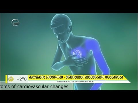 მარფანის სინდრომი   - უიშვიათესი გენეტიკური დაავადება