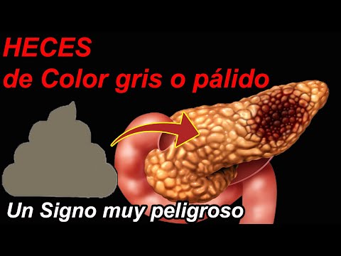 Si tus HECES son <strong>de</strong> ESTE <strong>COLOR</strong>, es muy posible que tengas un Páncreas Enfermo